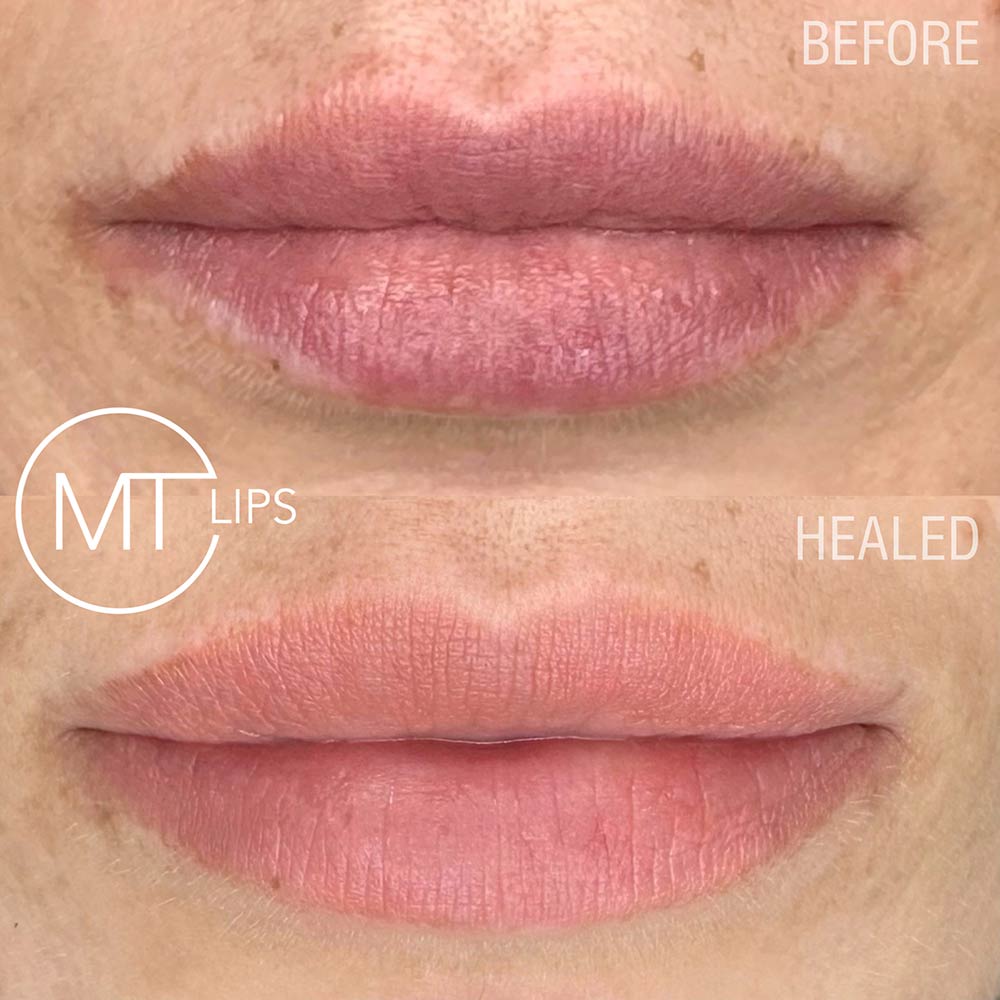 Before and after results of treated lips