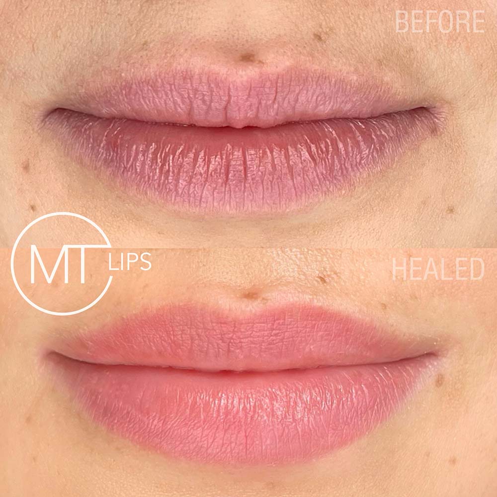 Before and after results of treated lips