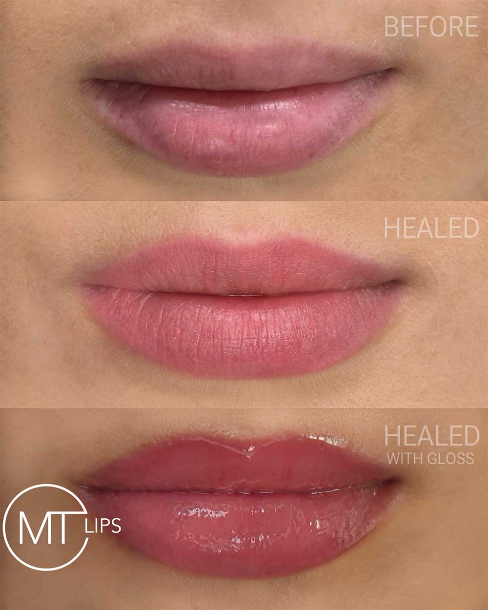 Before and after results of treated lips