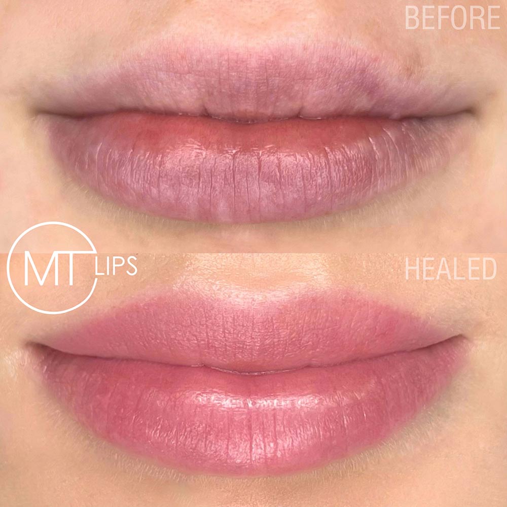 Before and after results of treated lips