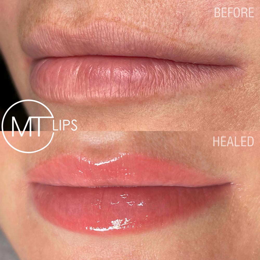 Before and after results of treated lips