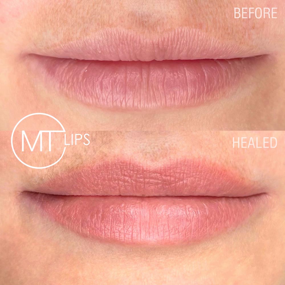 Before and after results of treated lips