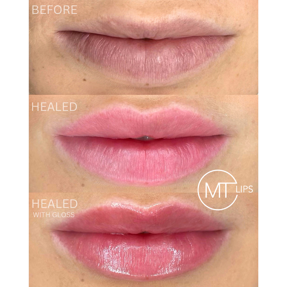 Before and after results of treated lips