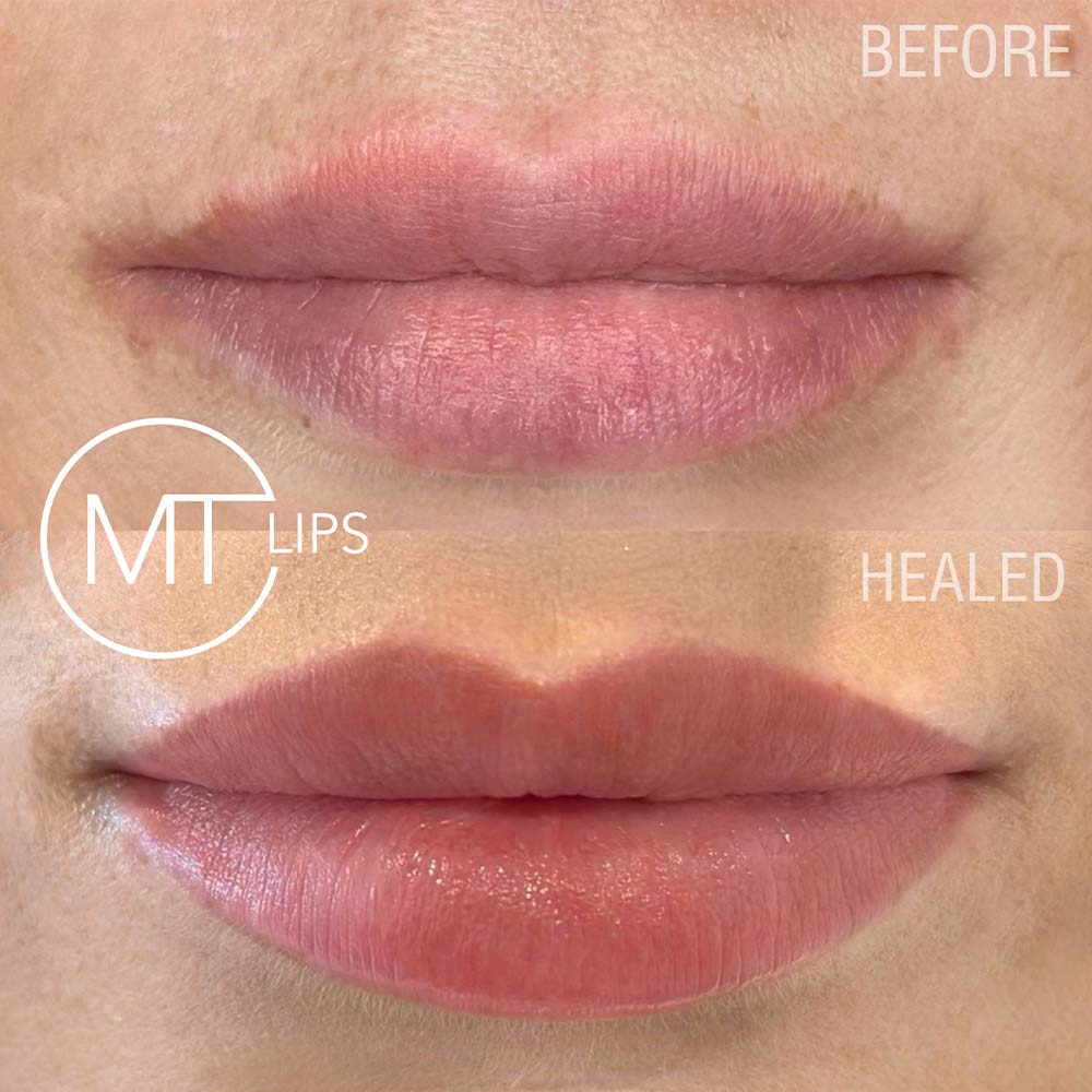 Before and after results of treated lips