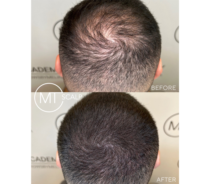 Results of the MT Scalp treatment