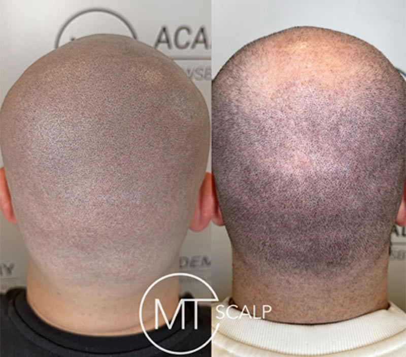 Results of the MT Scalp treatment