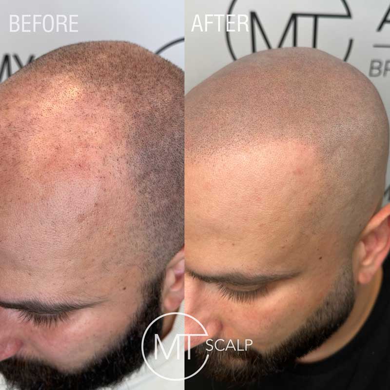 Hair restoration treatment