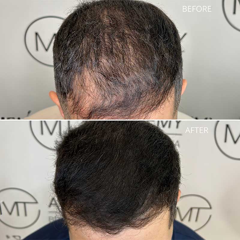 A co worker at MT does the MT Scalp treatment on a man