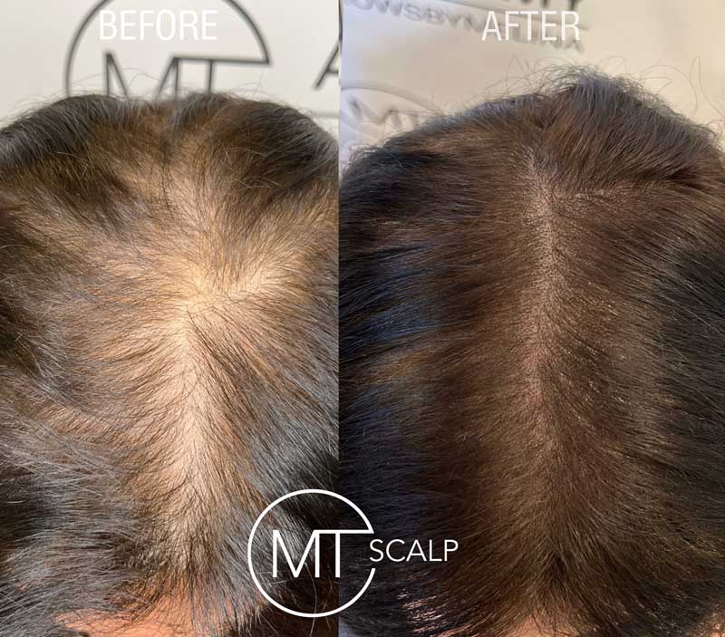 A co worker at MT does the MT Scalp treatment on a woman
