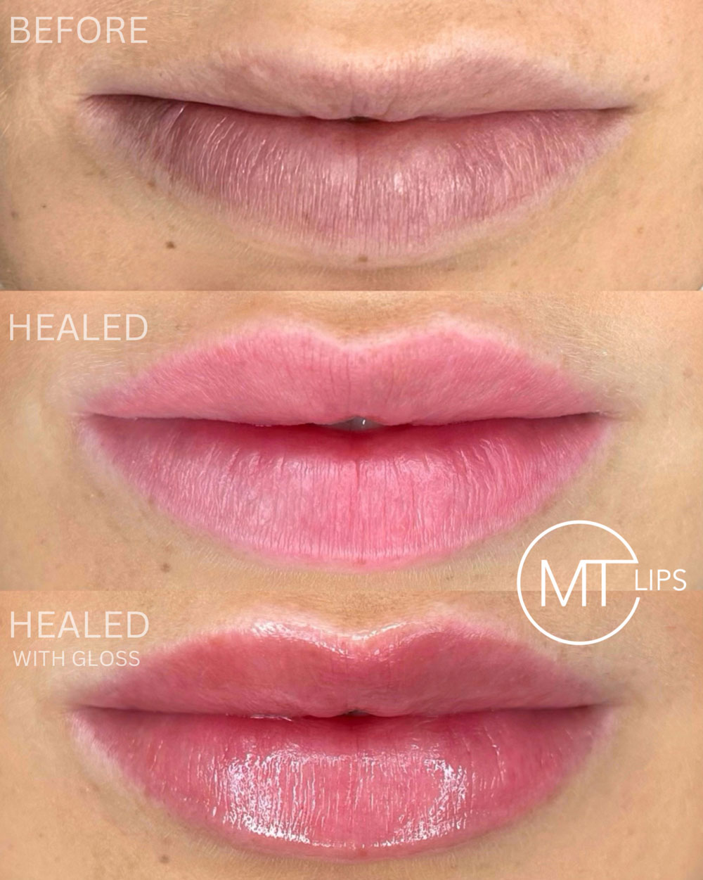 Before under and healed photo of lip blush lips