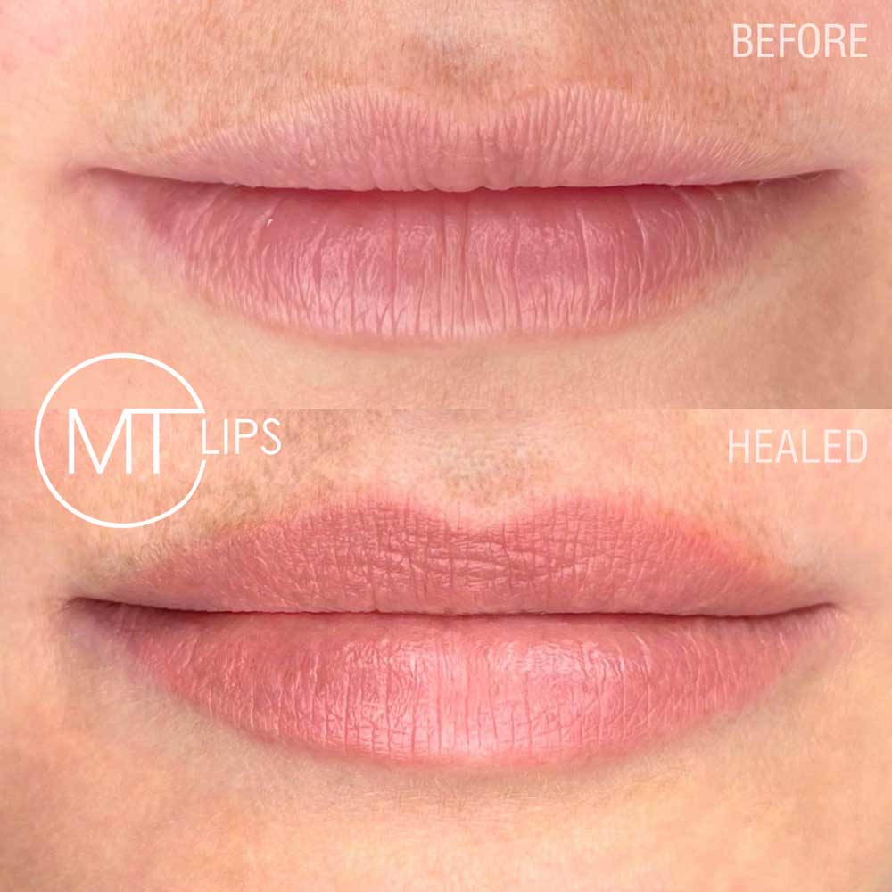 Before and after results of treated lips