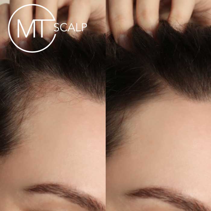Hair restoration treatment